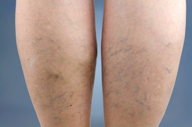 Tinea Versicolor On Legwomen's Compression Tights - Varicose Vein Support  & Leg Shaping