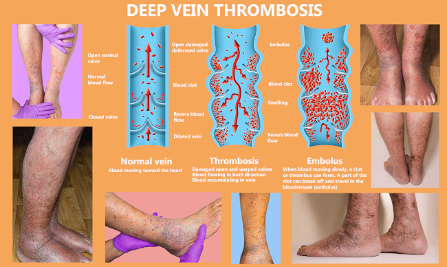 Should I Wear Compression Socks with Deep Vein Thrombosis (DVT)? – DSC